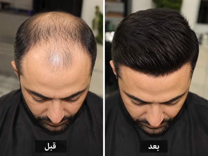 پروتز موی مردانه